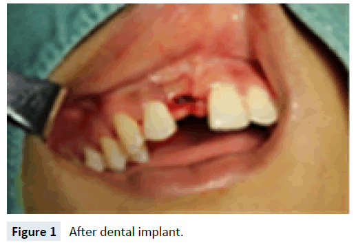 health-medical-economics-dental-implant